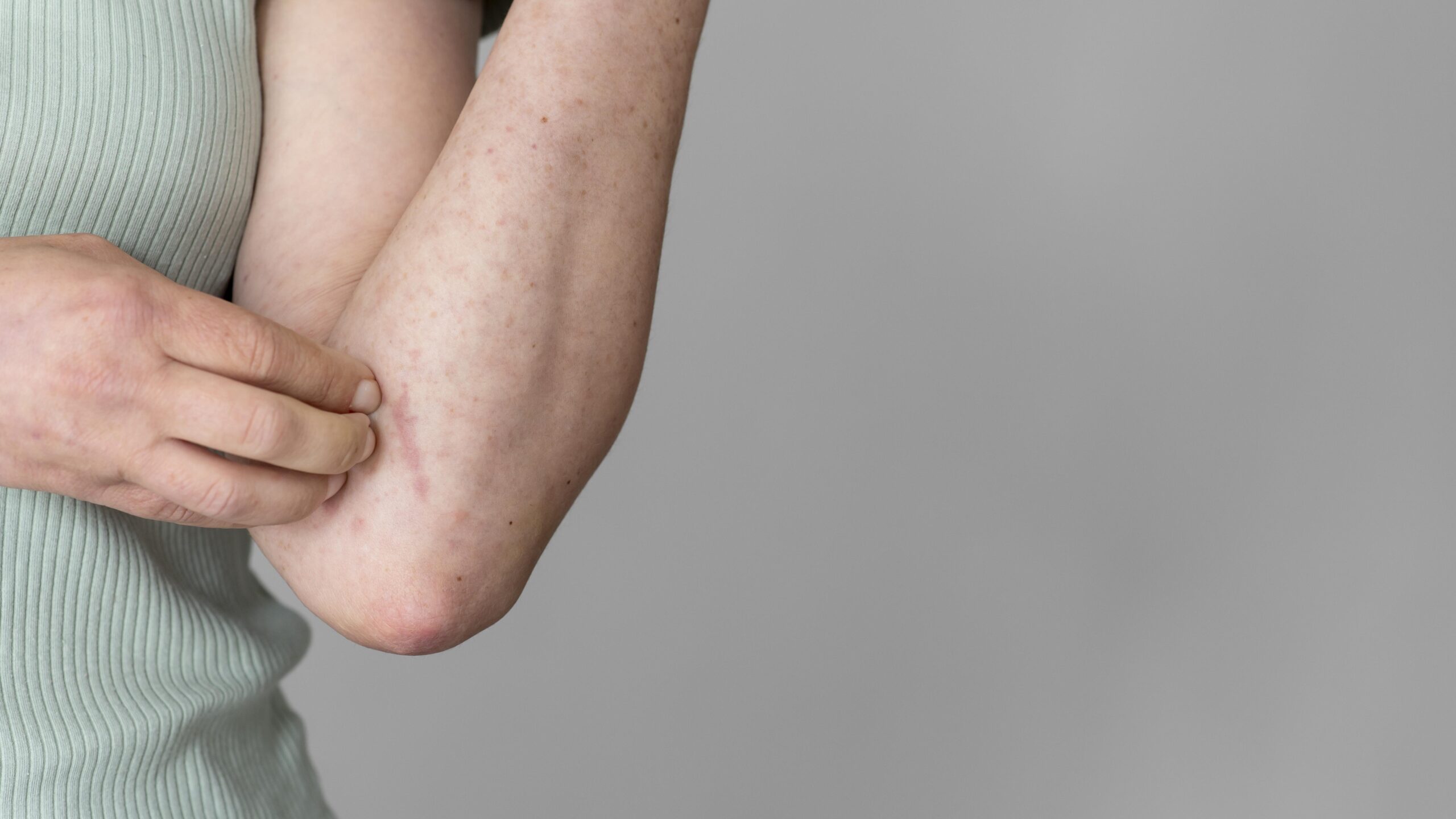 Dermatite atópica: o que é, sintomas, causas e tratamentos!