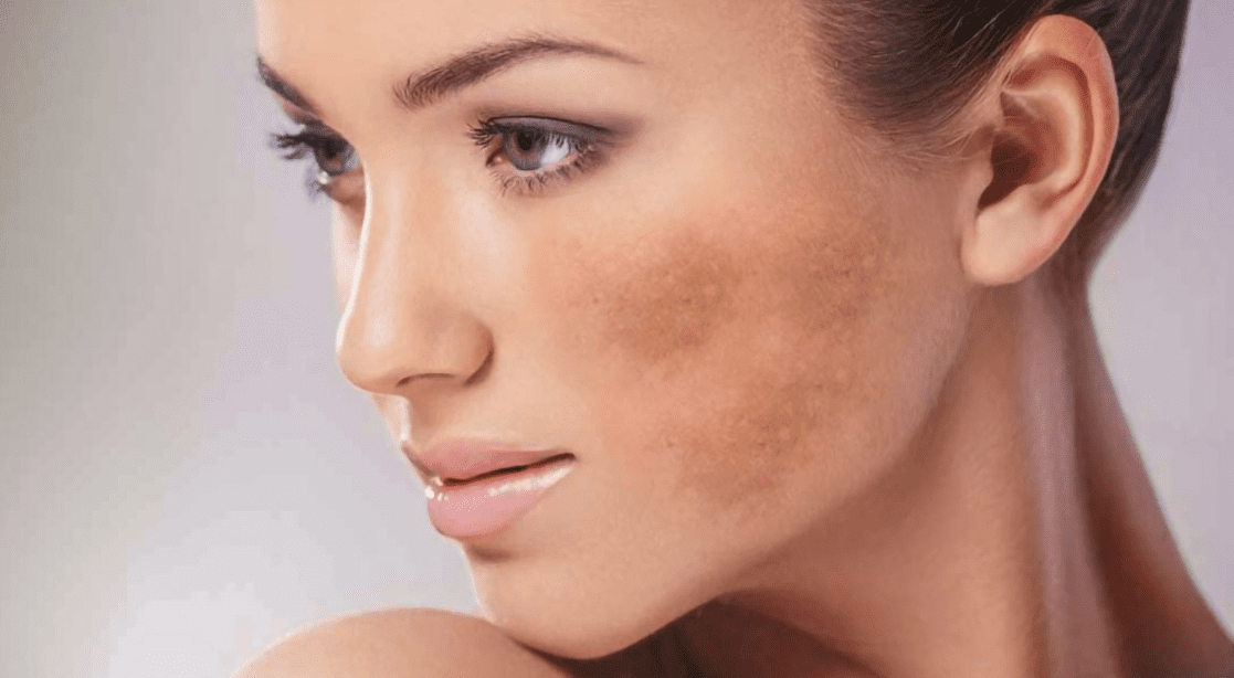 O que é melasma? Como prevenir e tratar!